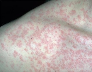 Measles outbreak in Geneva