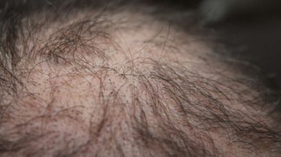 Does stress cause hair loss?