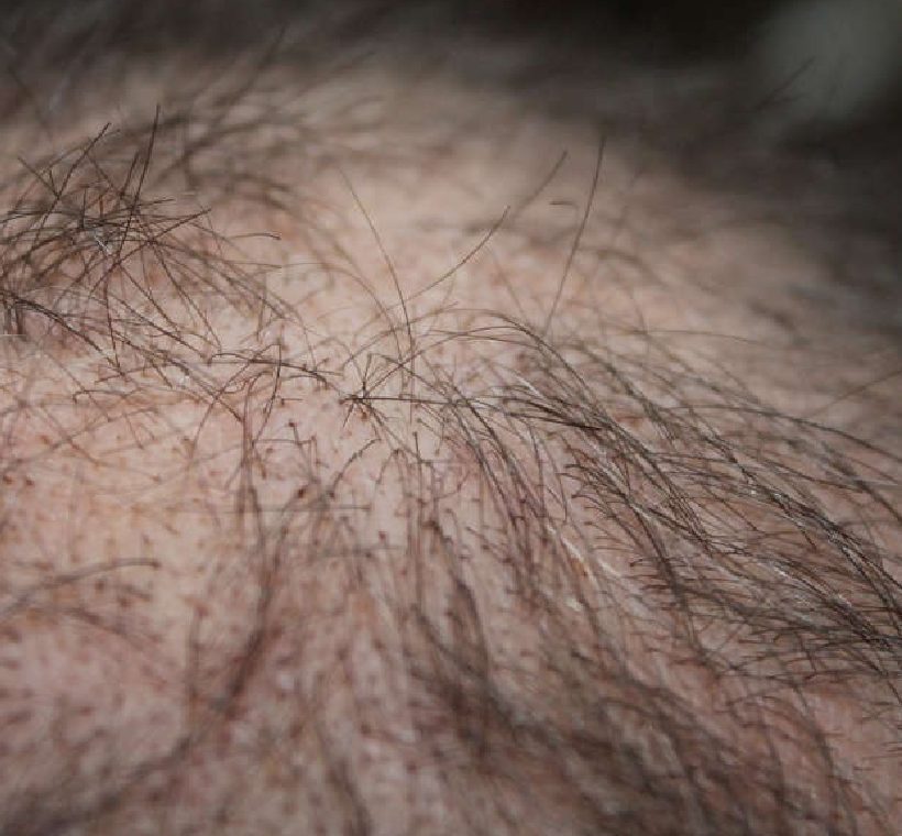 Does stress cause hair loss?